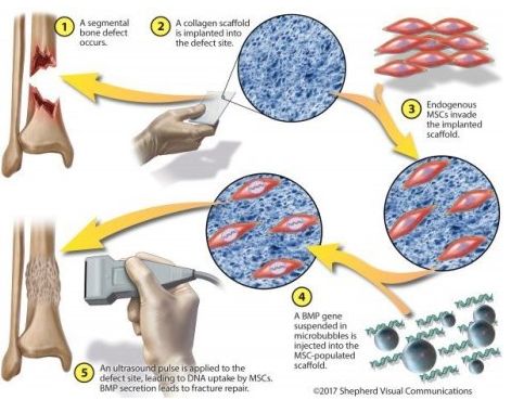 MDMC细胞治疗是骨移植有效的替代方法
