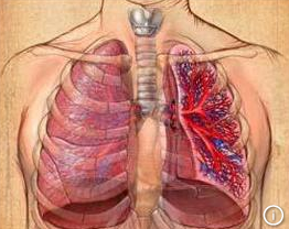 肺纤维化治疗——肺纤维化的早期症状有哪些