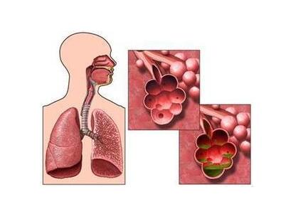 肺纤维化治疗——原发性肺纤维化症状