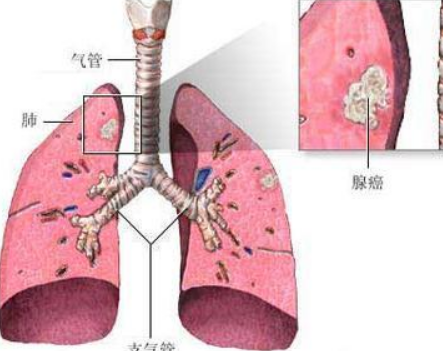 肺纤维化治疗--双肺纤维化的症状表现有哪些