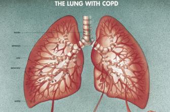 肺纤维化治疗——肺纤维化的护理方法有哪些