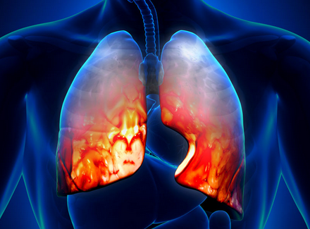 肺纤维化治疗——什么原因导致肺纤维化