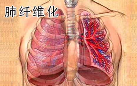 肺纤维化治疗——肺纤维化严不严重