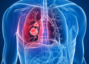 肺纤维化治疗——肺纤维化患者适合吃哪些食物