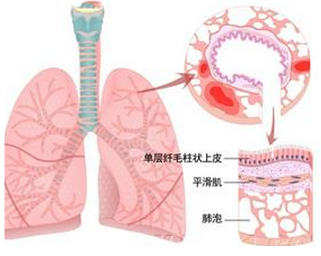 肺纤维化治疗——小儿肺纤维化症状介绍