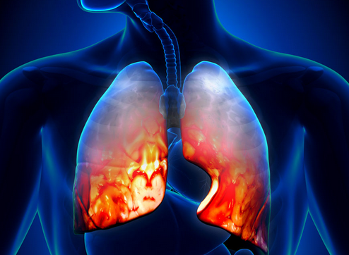 肺纤维化治疗——肺纤维化在饮食上应如何进行护理